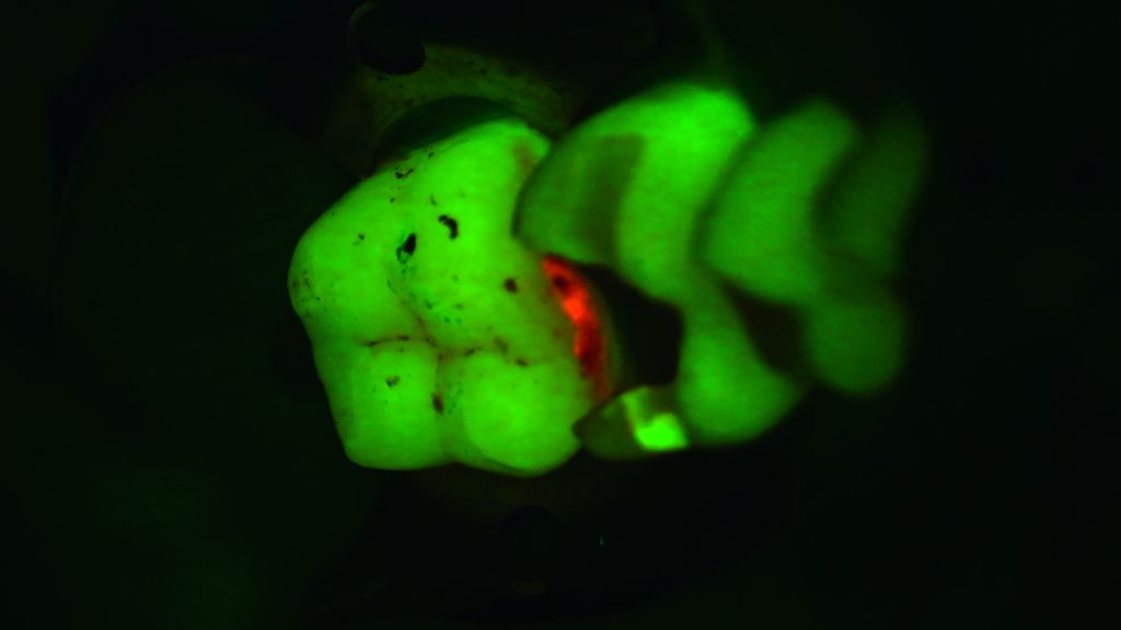 Identification of caries lesion using the Fluorescence Mode