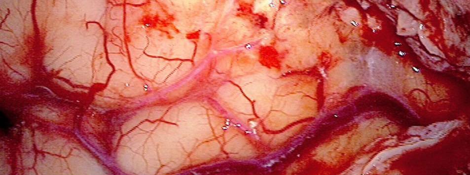 Depiction of a tumor under fluorescent light (BLUE 400 - the red areas indicate the tumor) and under normal lighting conditions (second image).