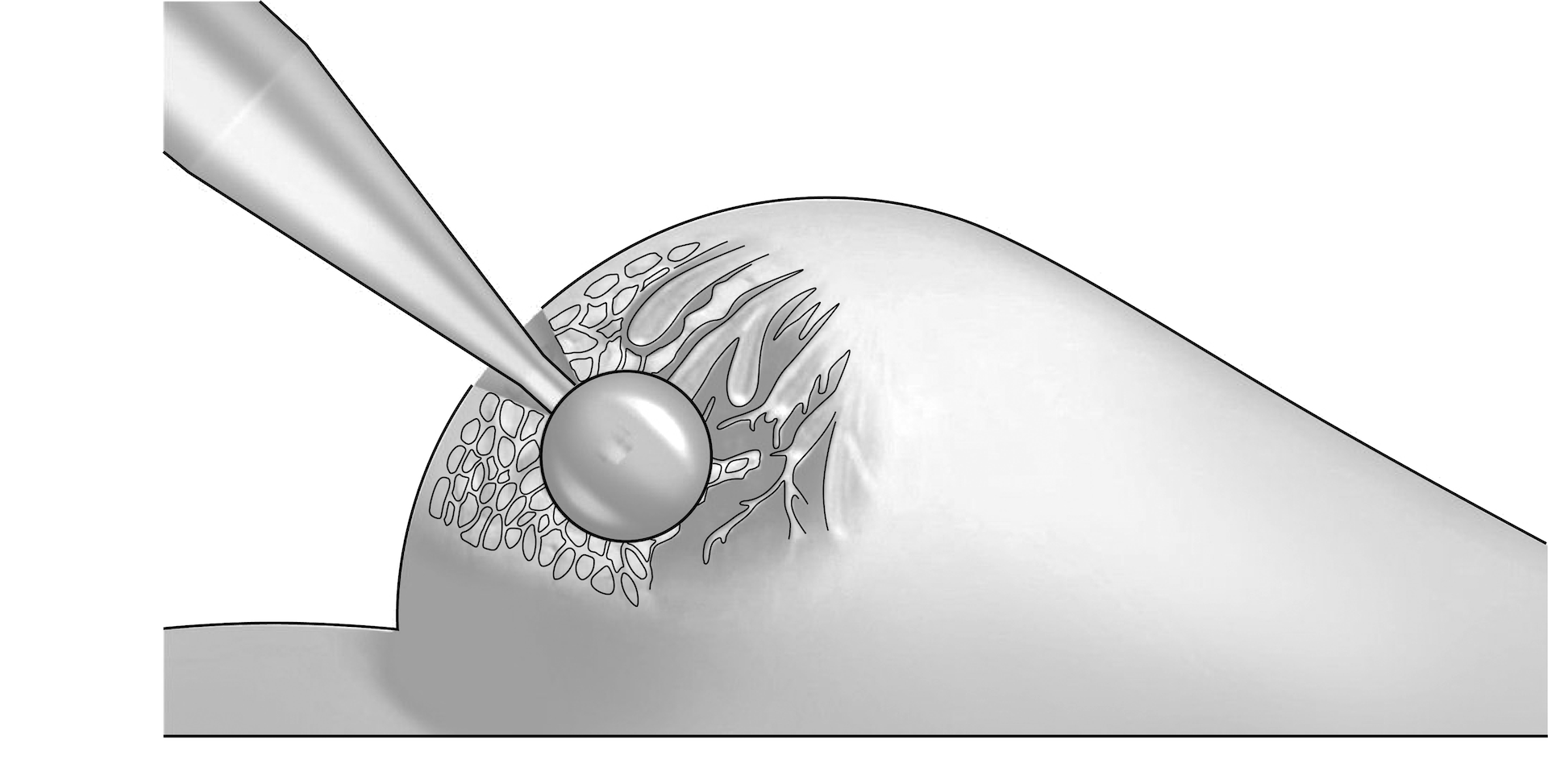 The suitable applicator is determined and positioned in the tumor cavity.