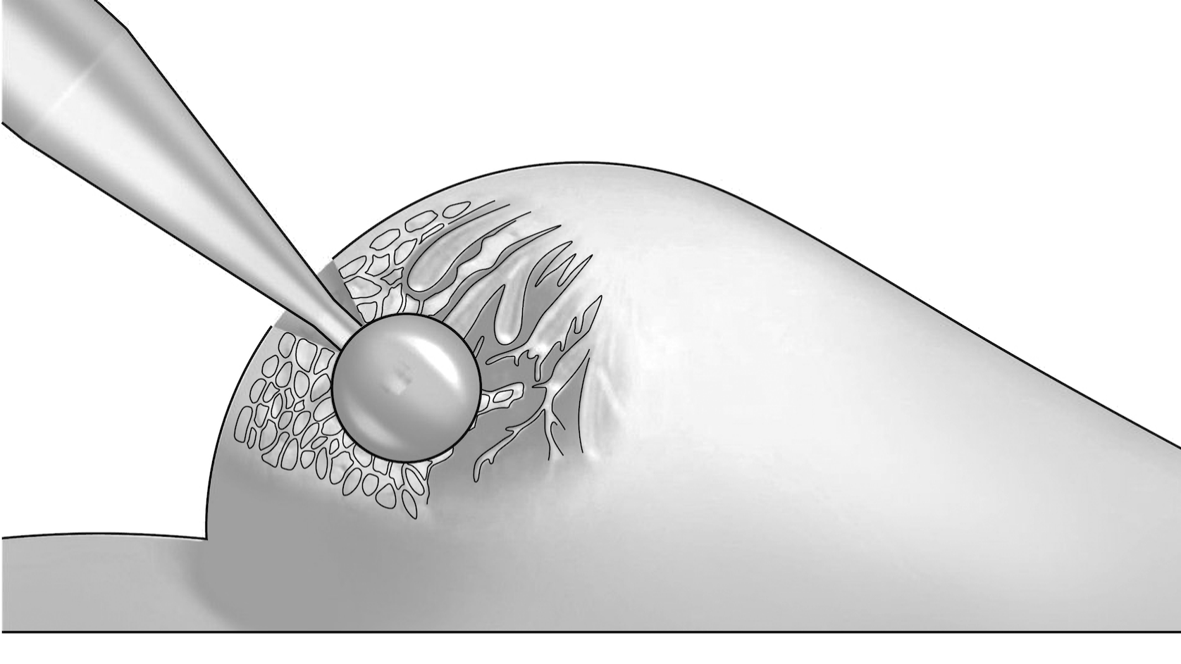 The suitable applicator is determined and positioned in the tumor cavity.