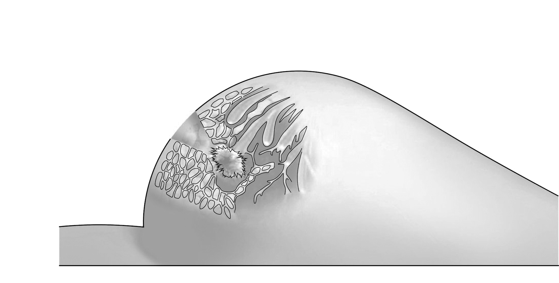 A minimally invasive entry point is created during surgery.