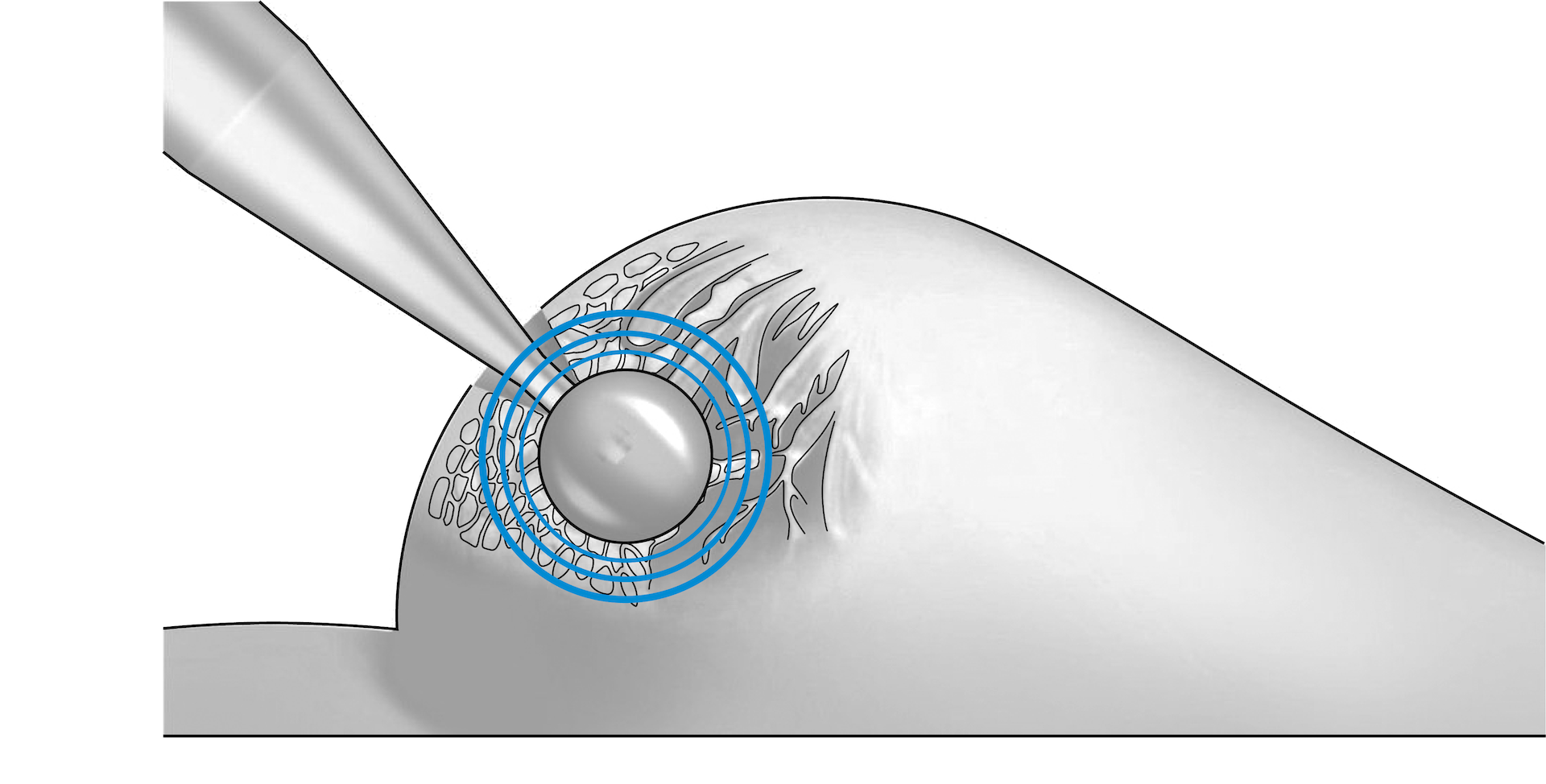 The tumor bed is irradiated locally for approx. 30 minutes.