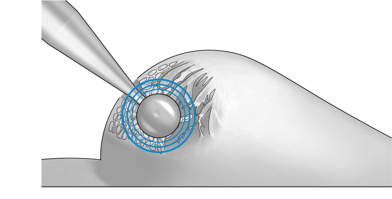 ZEISS sustainability - Hope in the fight against breast cancer