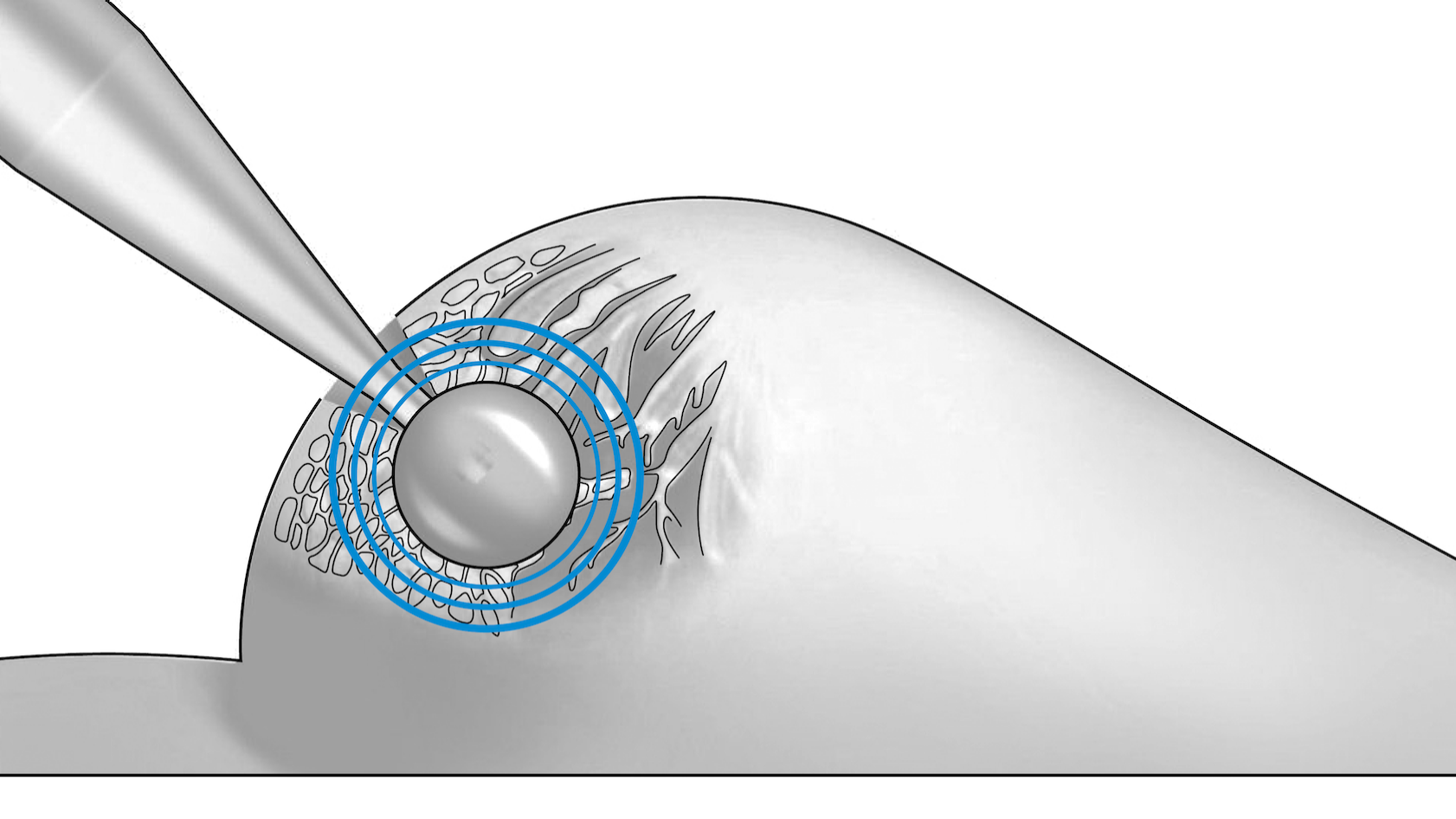 The tumor bed is irradiated locally for approx. 30 minutes.