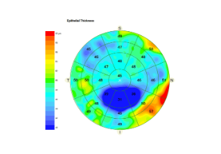 Preview image of ZEISS CIRRUS Epithelial Thickness Mapping