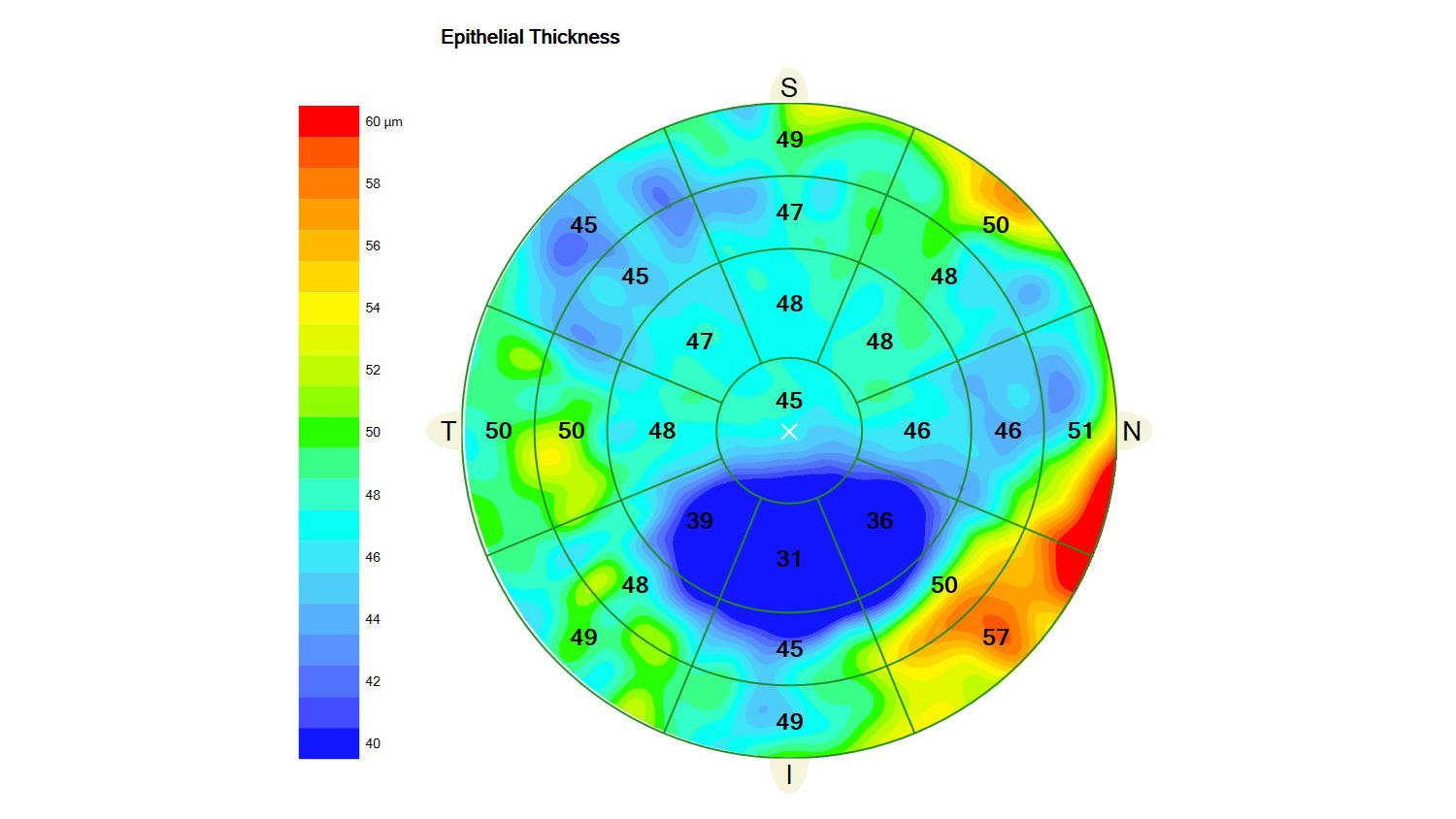 ZEISS CIRRUS Epithelial Thickness Mapping