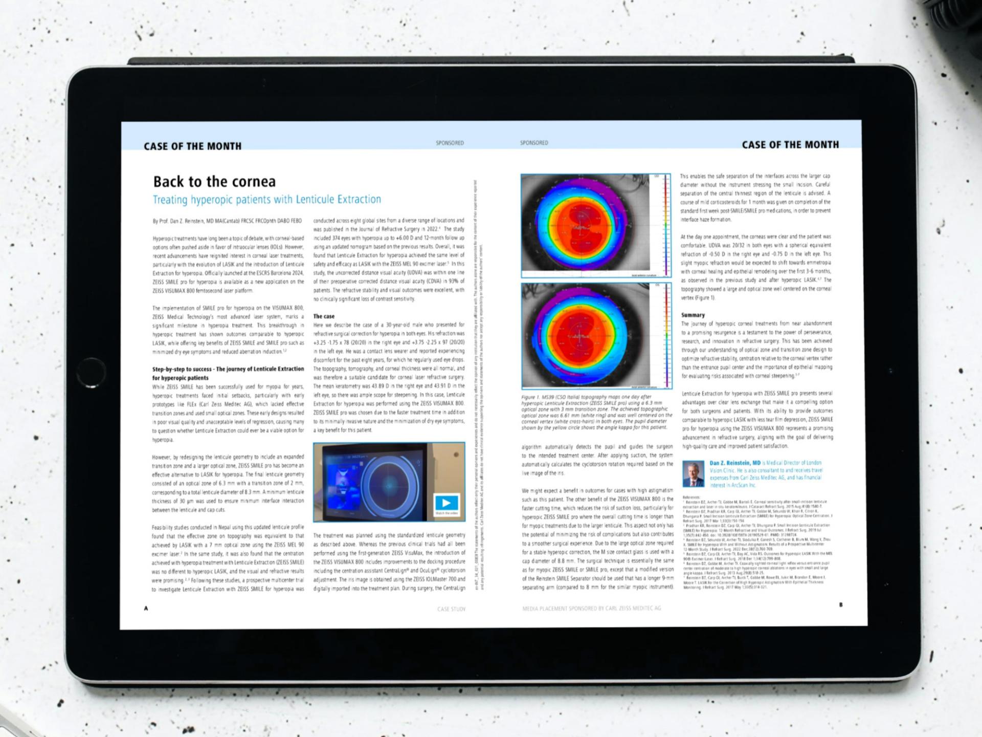 Study Case - SMILE pro for Hyperopia - Prof. Reinstein
