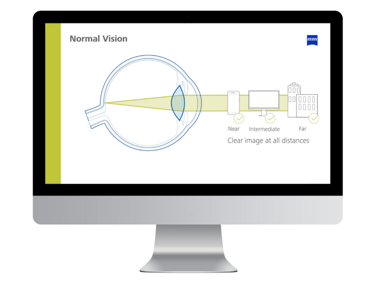 ZEISS AI IOL Calculator