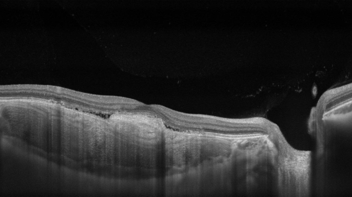 OCT image through the fovea. The tumor is located within the choroid, and the retina is compressed anteriorly