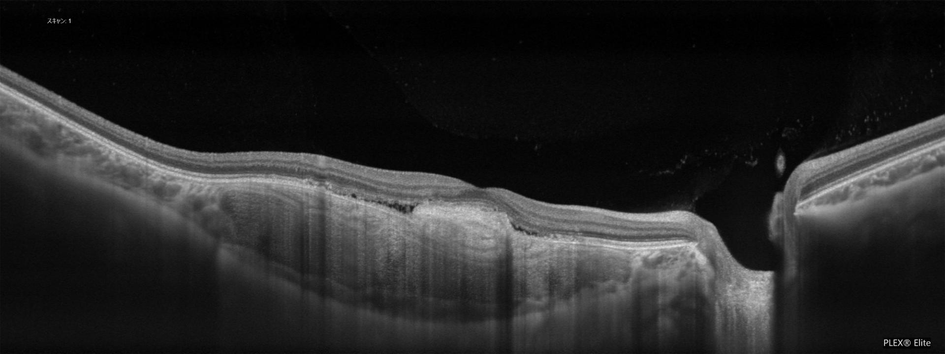 OCT image through the fovea. The tumor is located within the choroid, and the retina is compressed anteriorly