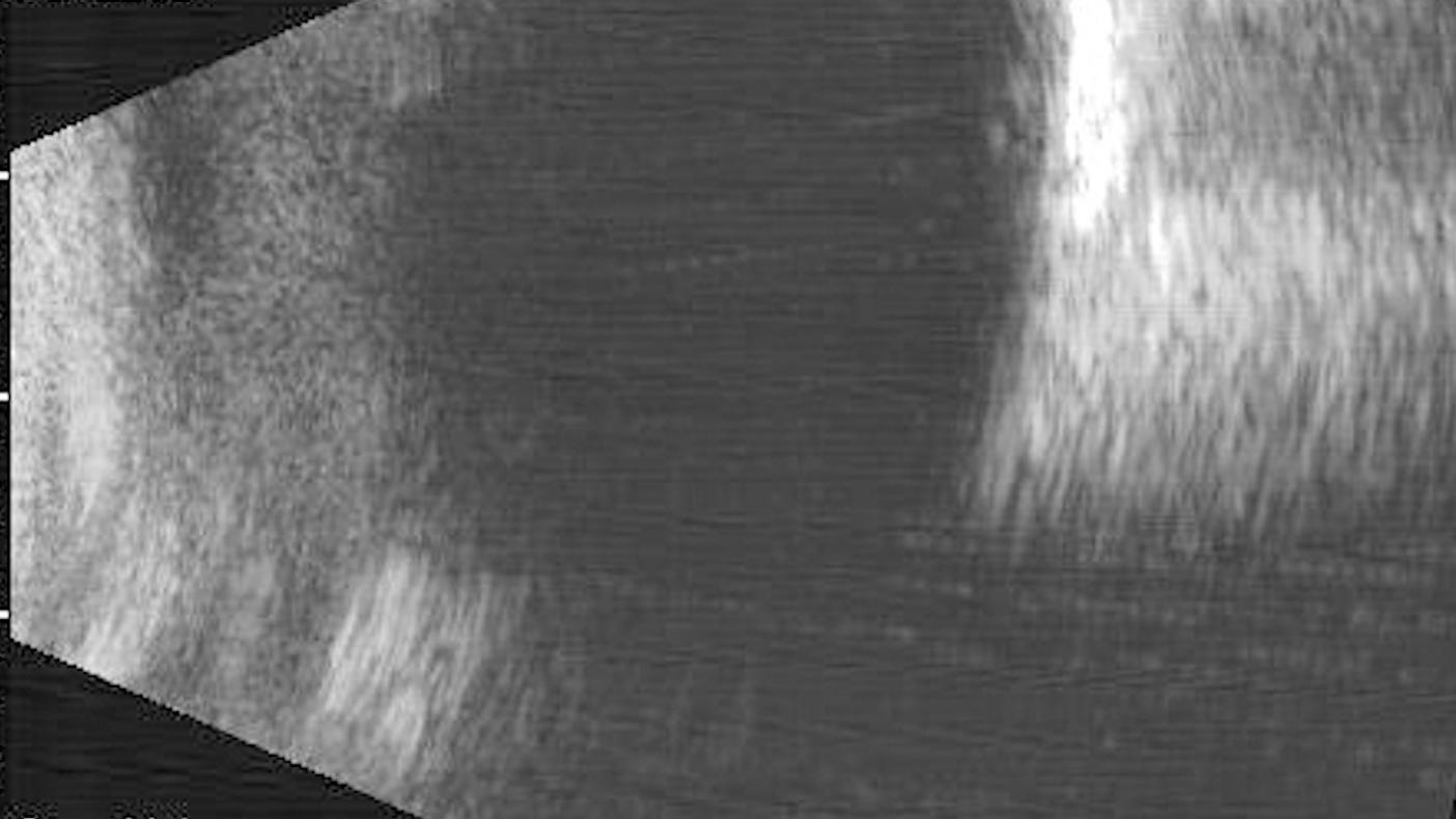 Ultrasound B-mode image. The lesion shows hyperintense reflections and an acoustic shadow behind it.
