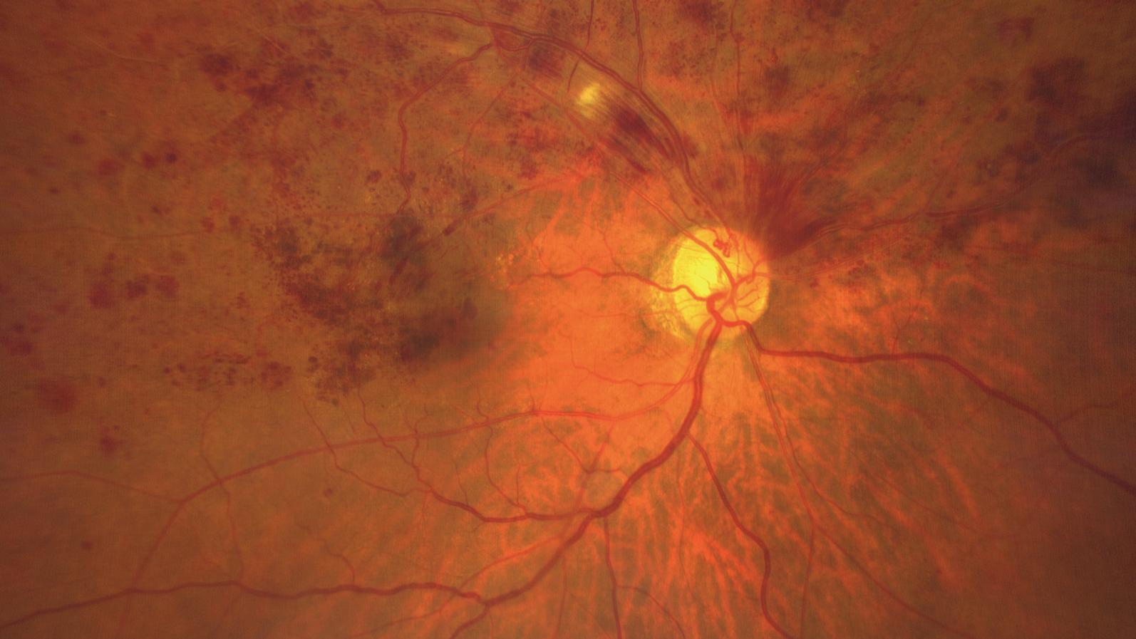 Hemispheric Central Retinal Vein Occlusion [75-yr old male]