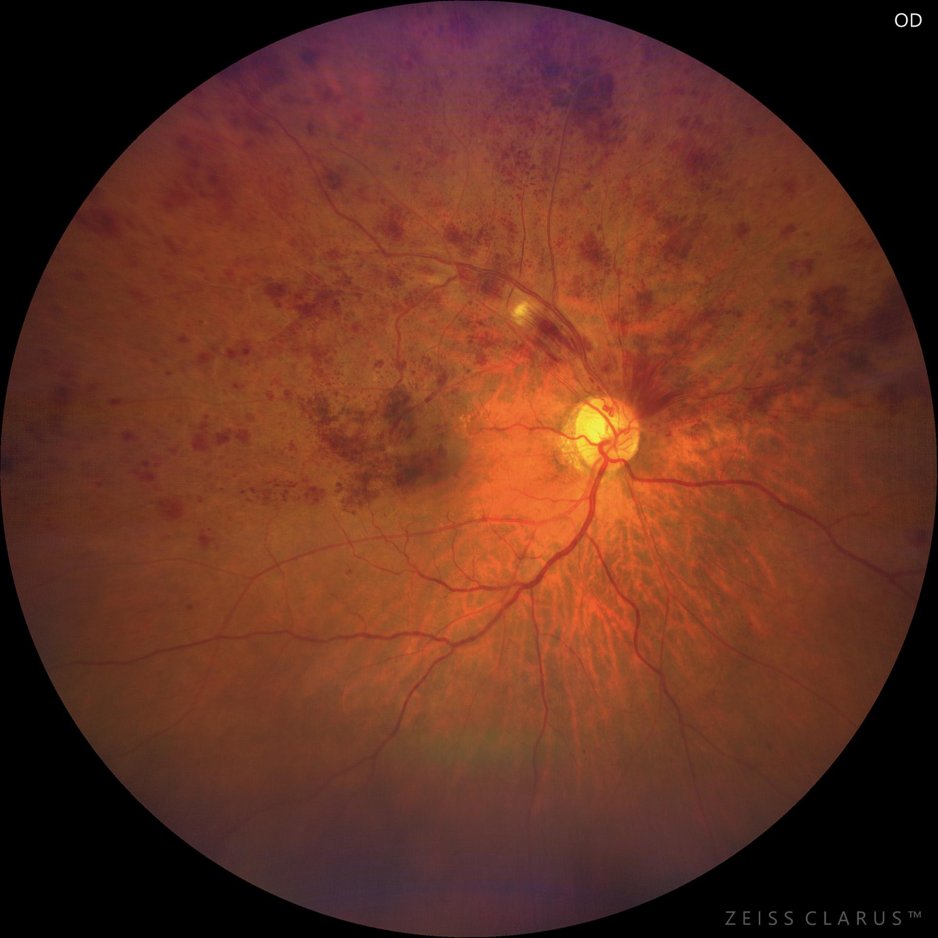 WF 133° image. Retinal hemorrhages seen throughout the upper hemisection.
