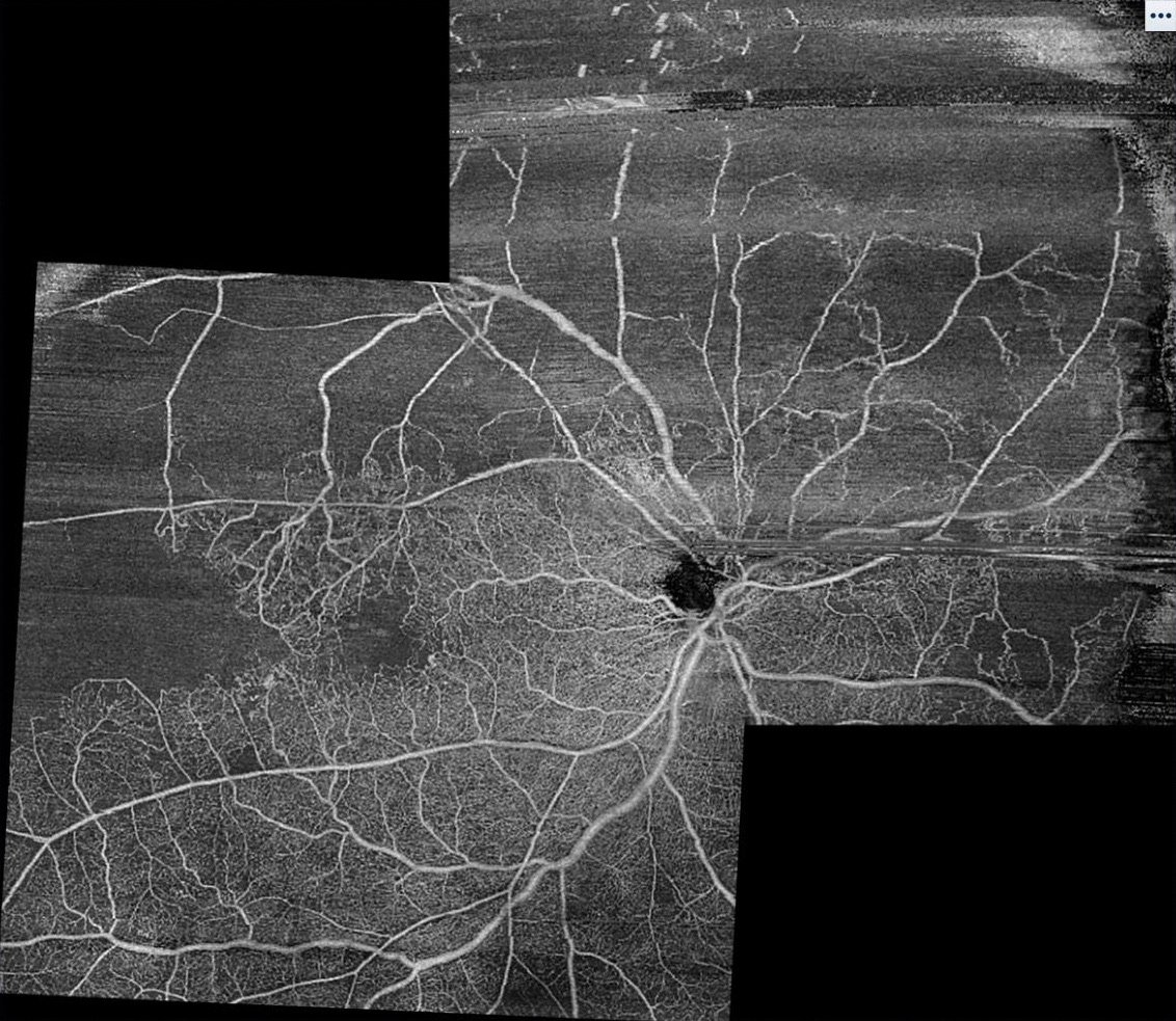 OCT angiography 12 × 12 mm montage image