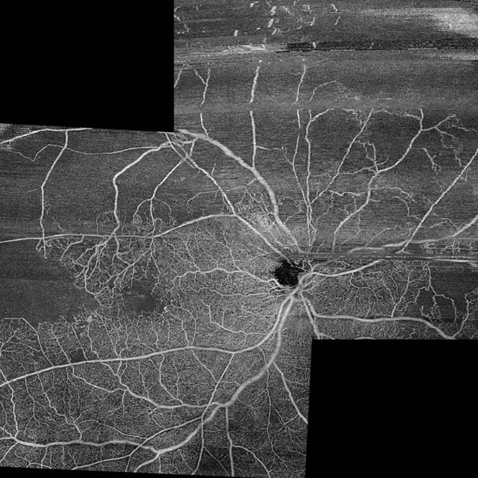 OCT angiography 12 × 12 mm montage image