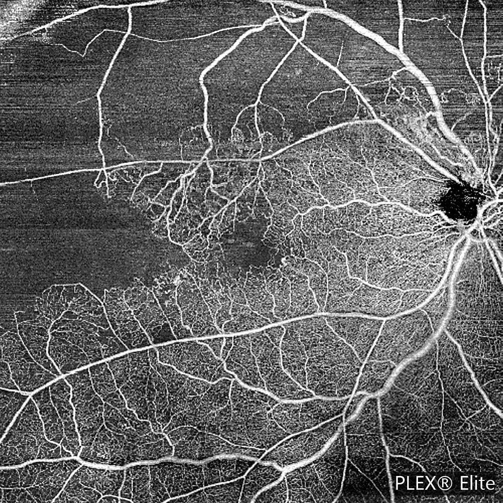 12 × 12 mm OCT angiography of the macula, retinal surface layer slab image