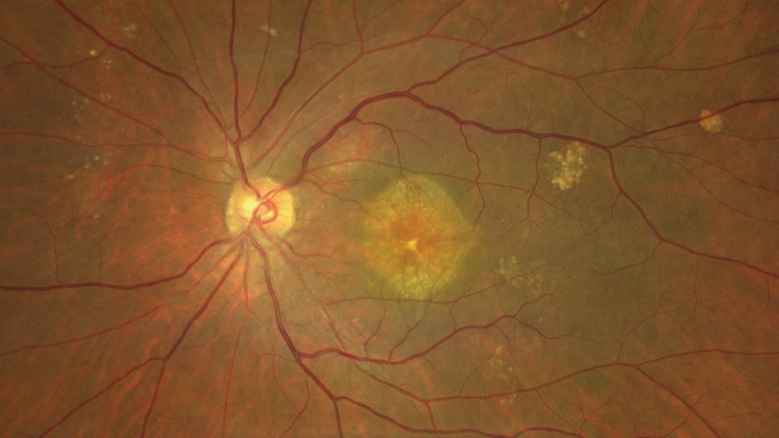 Age-related Macular Degeneration (AMD type 1 CNV) Case 2 [82-yr old male]
