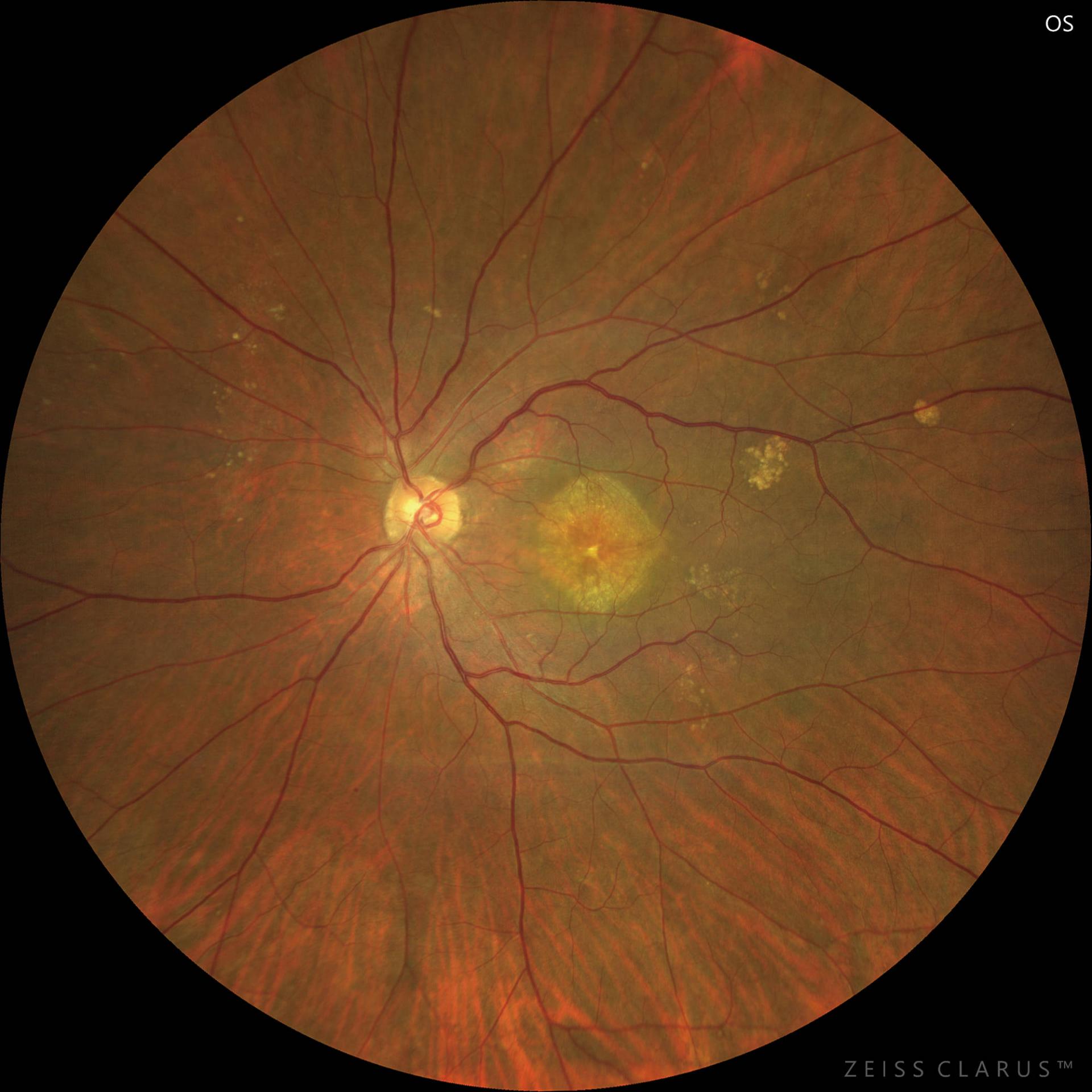WF 133° magnified image of the macula. Grayish-white foci and serous retinal detachment observed in the macula.