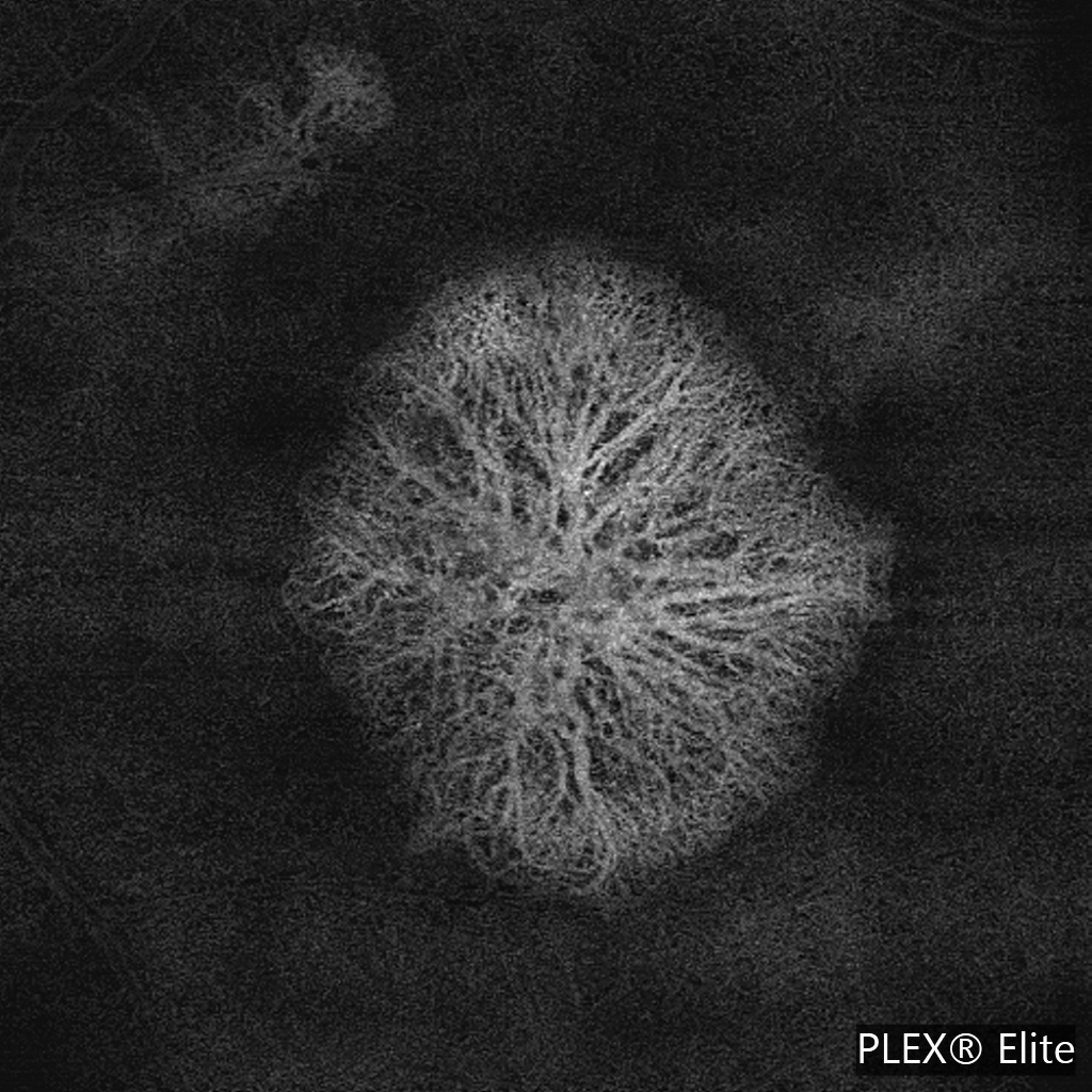 6 × 6 mm OCT angiography of the macula, avascular slab image. 