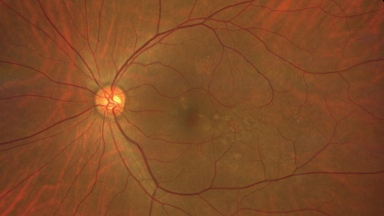 Age-related Macular Degeneration (PNV) Case 3 [69-yr old male]