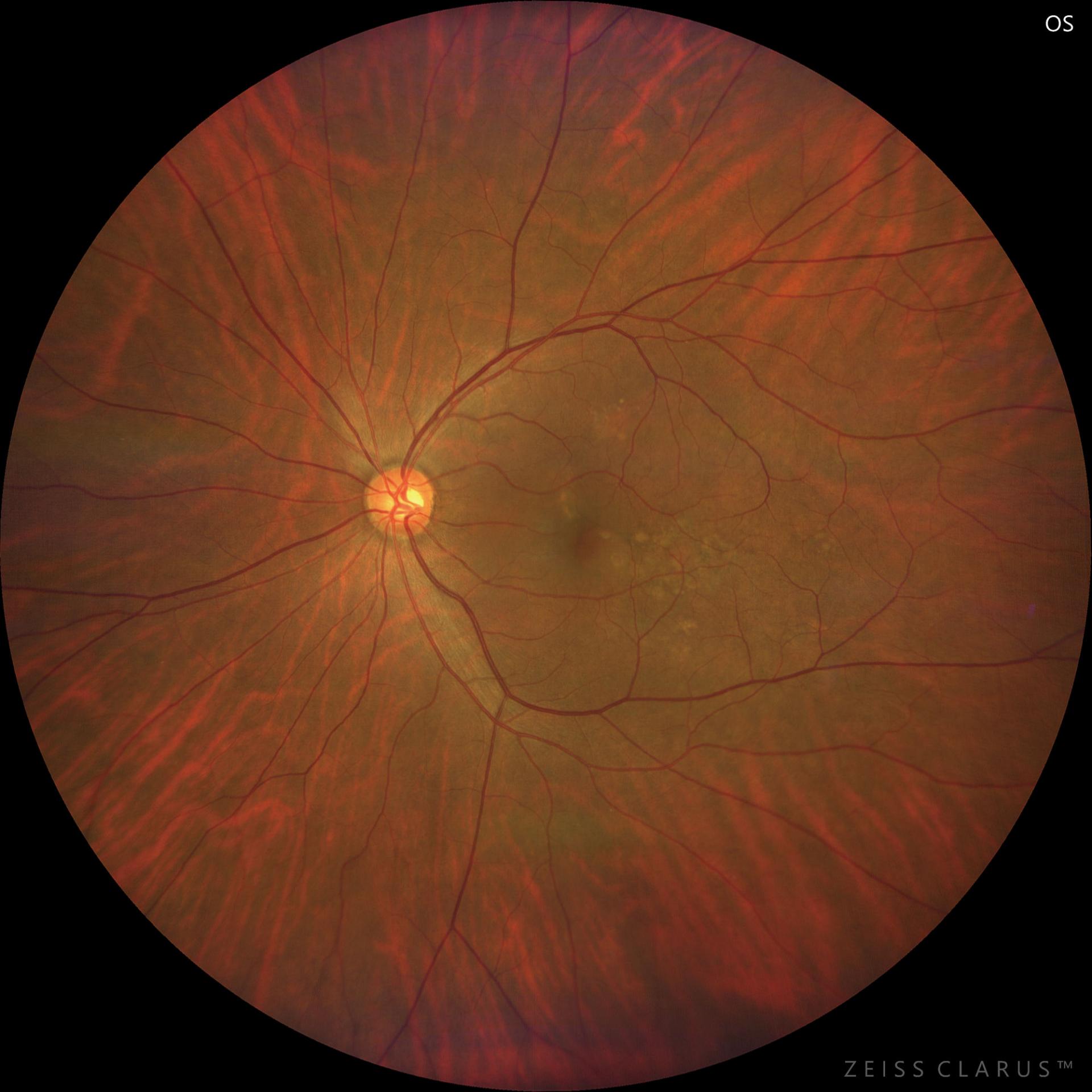 WF 133° magnified image of the macula