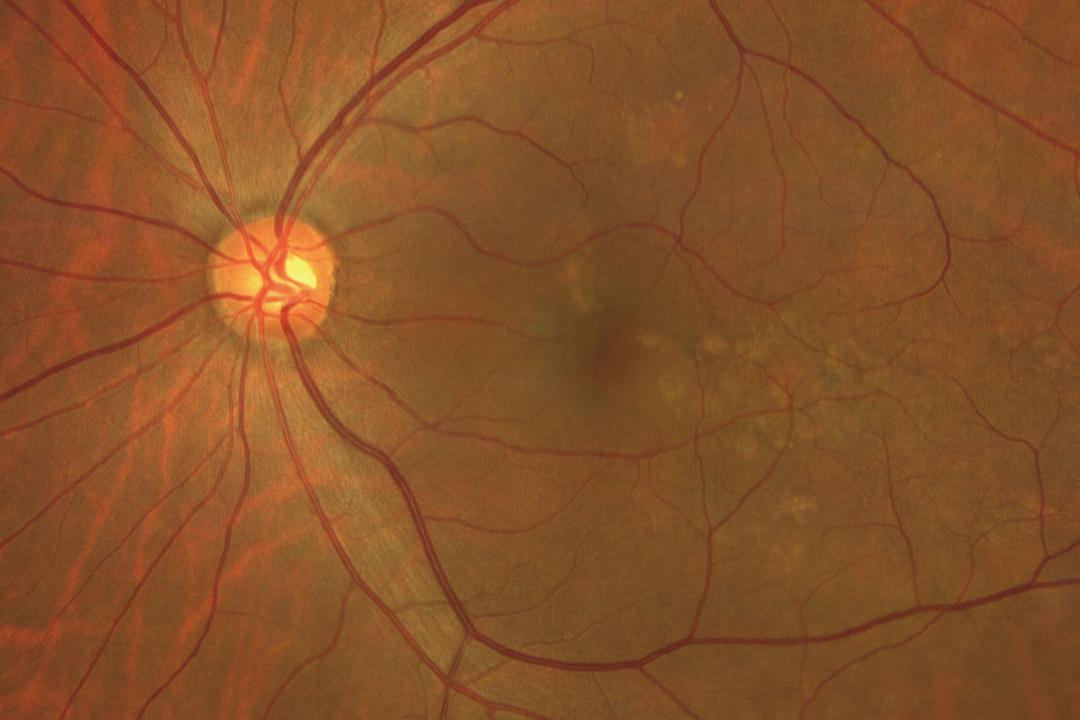 Age-related Macular Degeneration (PNV) Case 3