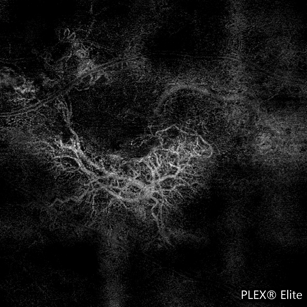 OCT angiography of macula 6 × 6 mm, ORCC slab image.