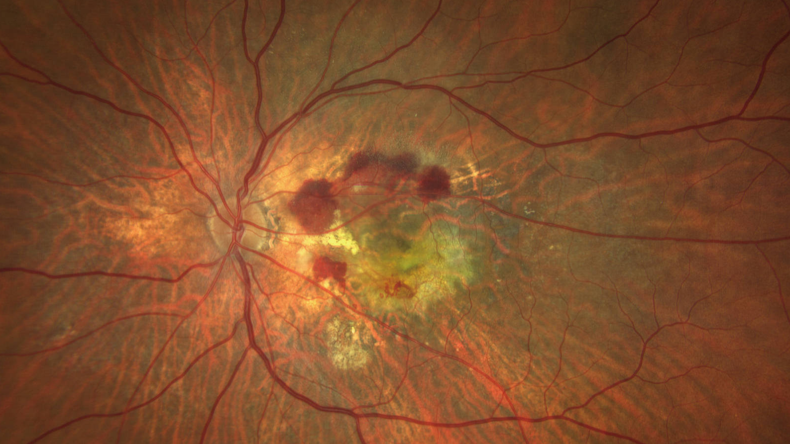 Age-related Macular Degeneration (AMD type 1 CNV) Case 1 [87-yr old male]