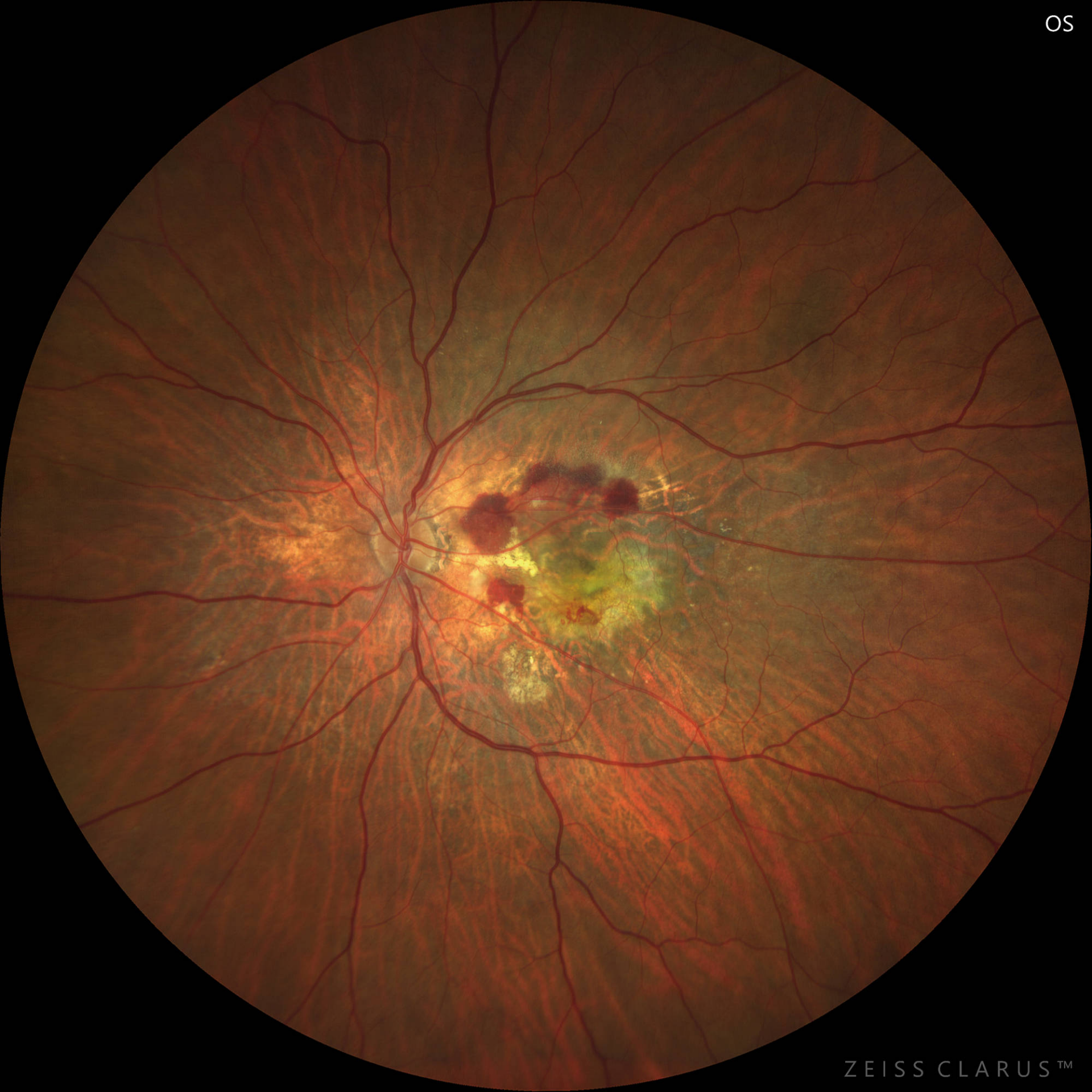 WF 133° magnified image of the macula. Subretinal hemorrhages and gray lesions visible in the macula.