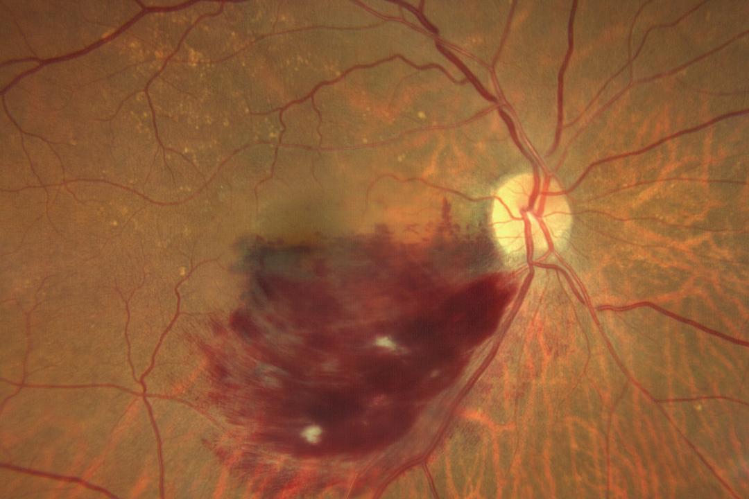 brain-retinal-vein-occlusion