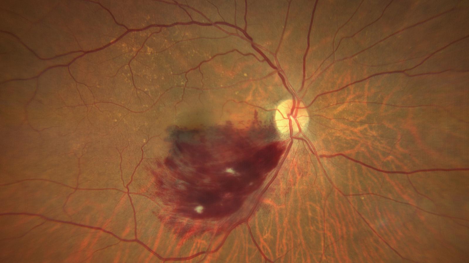 Branch Retinal Vein Occlusion Case 1 [80-yr old female]