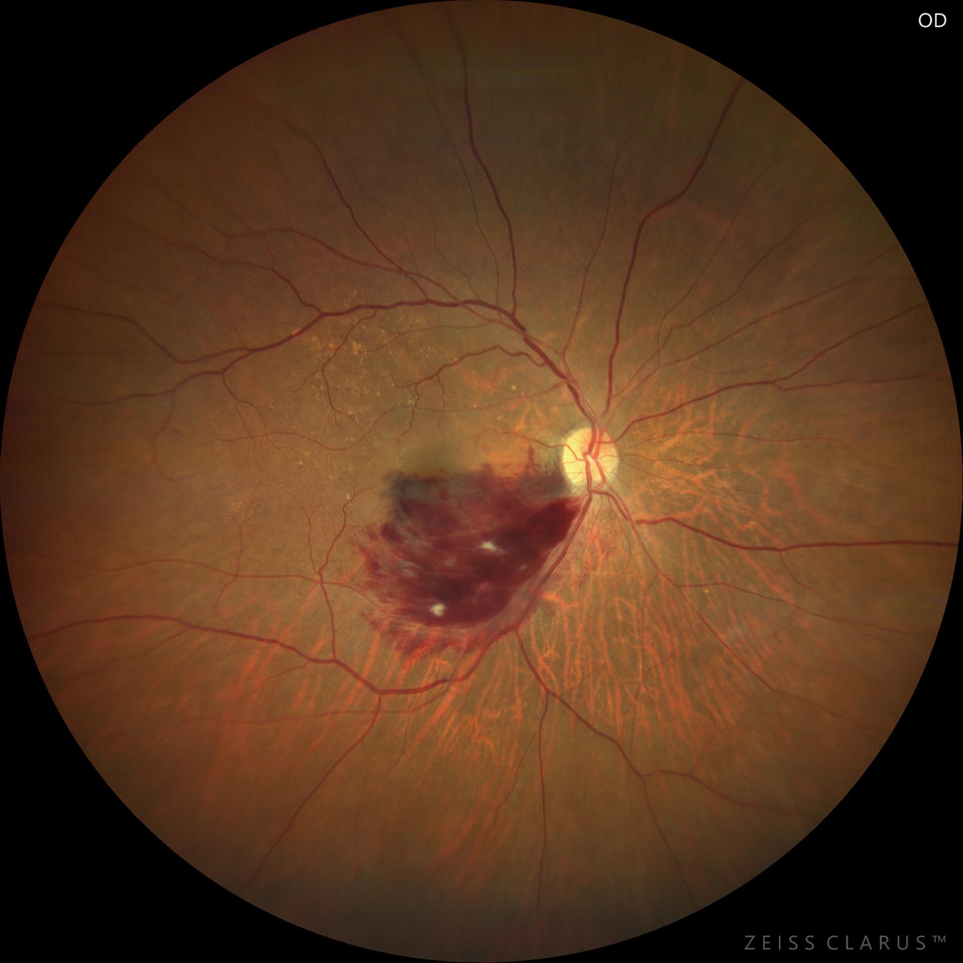 WF 133° magnified image of the macula. Retinal hemorrhages (flame-shaped hemorrhages) fanning out below the macula and soft leukocoria observed within the hemorrhages.