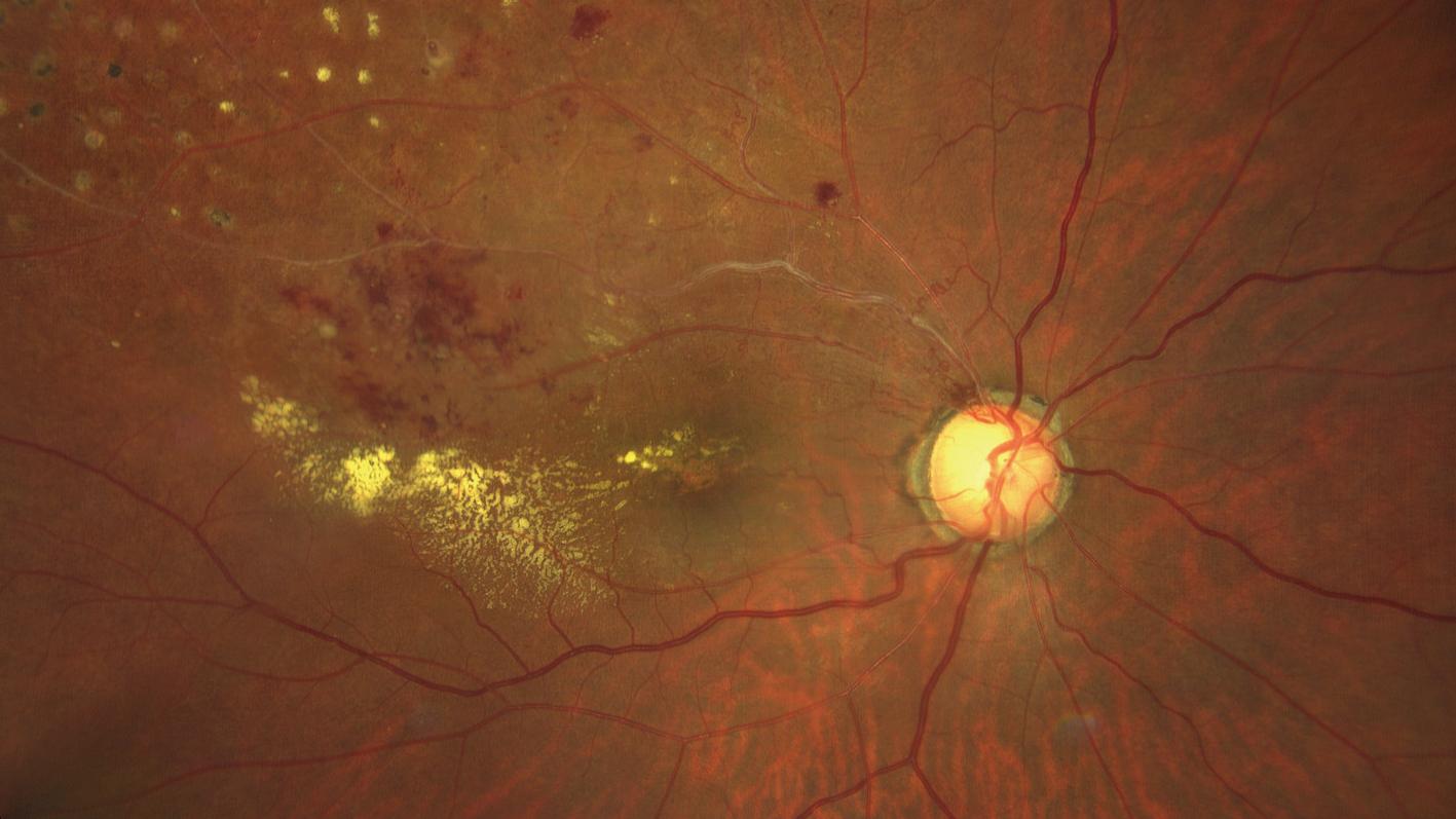 Branch Retinal Vein Occlusion Case 2 [68-yr old female]