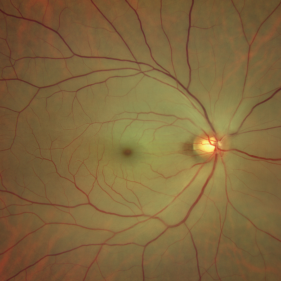 WF 133° magnified image of the macula. The entire fundus is milky white and cloudy because the inner retinal layer nourished by the interrupted retinal blood vessels is subject to ischemic necrosis. Cherry-red spots and edema in the macula are also observed. 