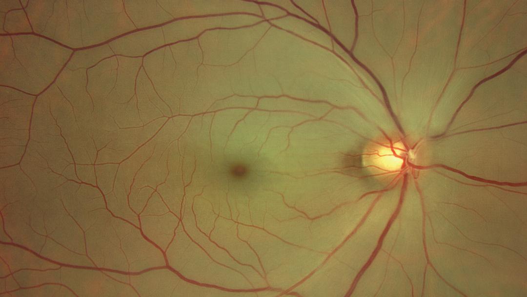 Central Retinal Artery Occlusion [50-yr old male]