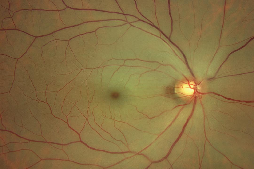 Central Retinal Artery Occlusion OS (CRAO) ​