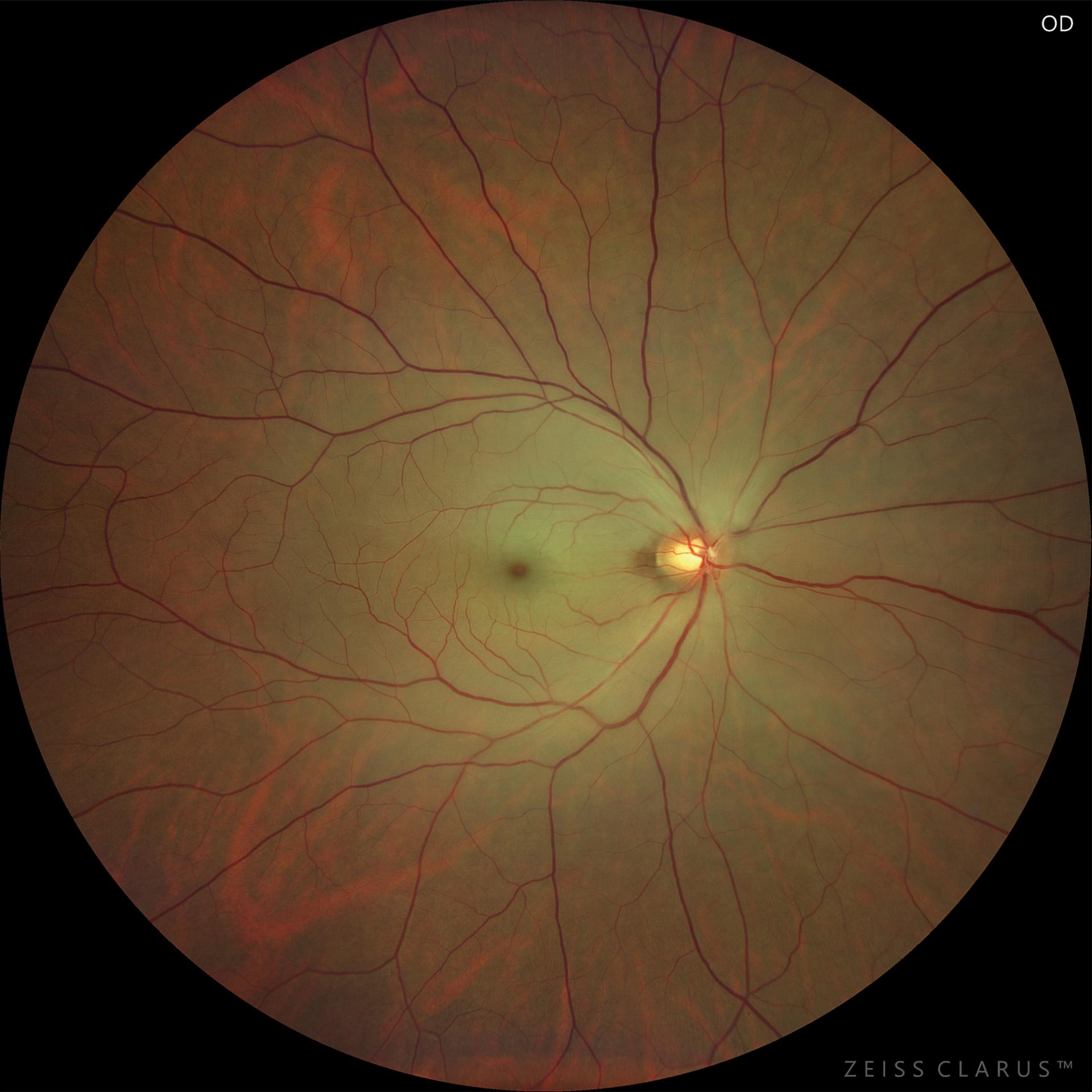 WF 133° magnified image of the macula. The entire fundus is milky white and cloudy because the inner retinal layer nourished by the interrupted retinal blood vessels is subject to ischemic necrosis. Cherry-red spots and edema in the macula are also observed.