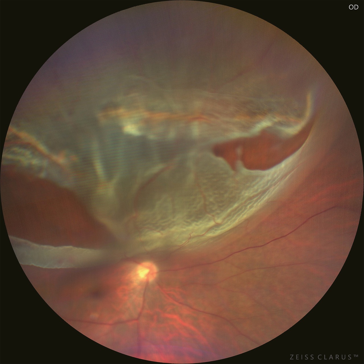 this is an image of a detached Retina taken “automatically”. The image is focused near the rear pole.