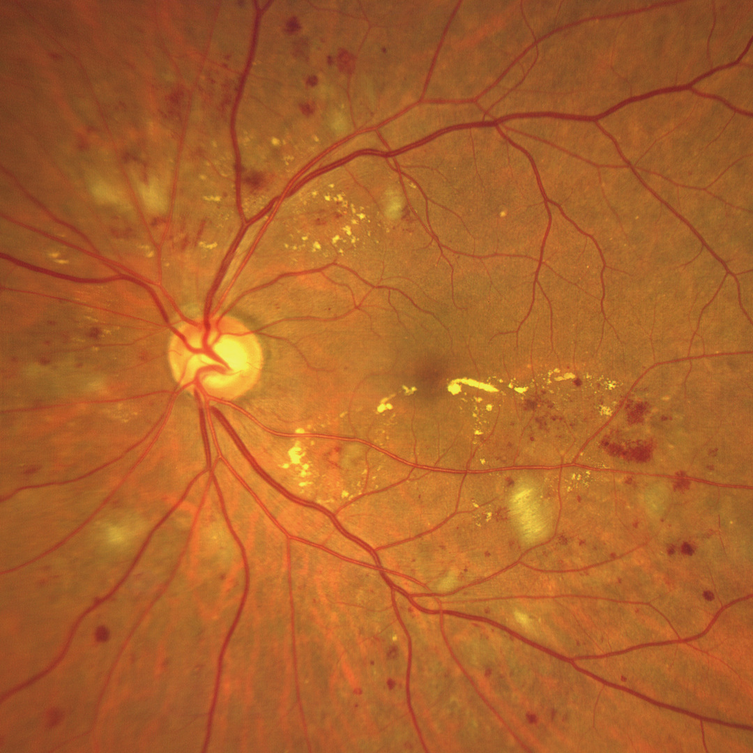 WF 133° magnified image of the macular subauricular hemorrhage area