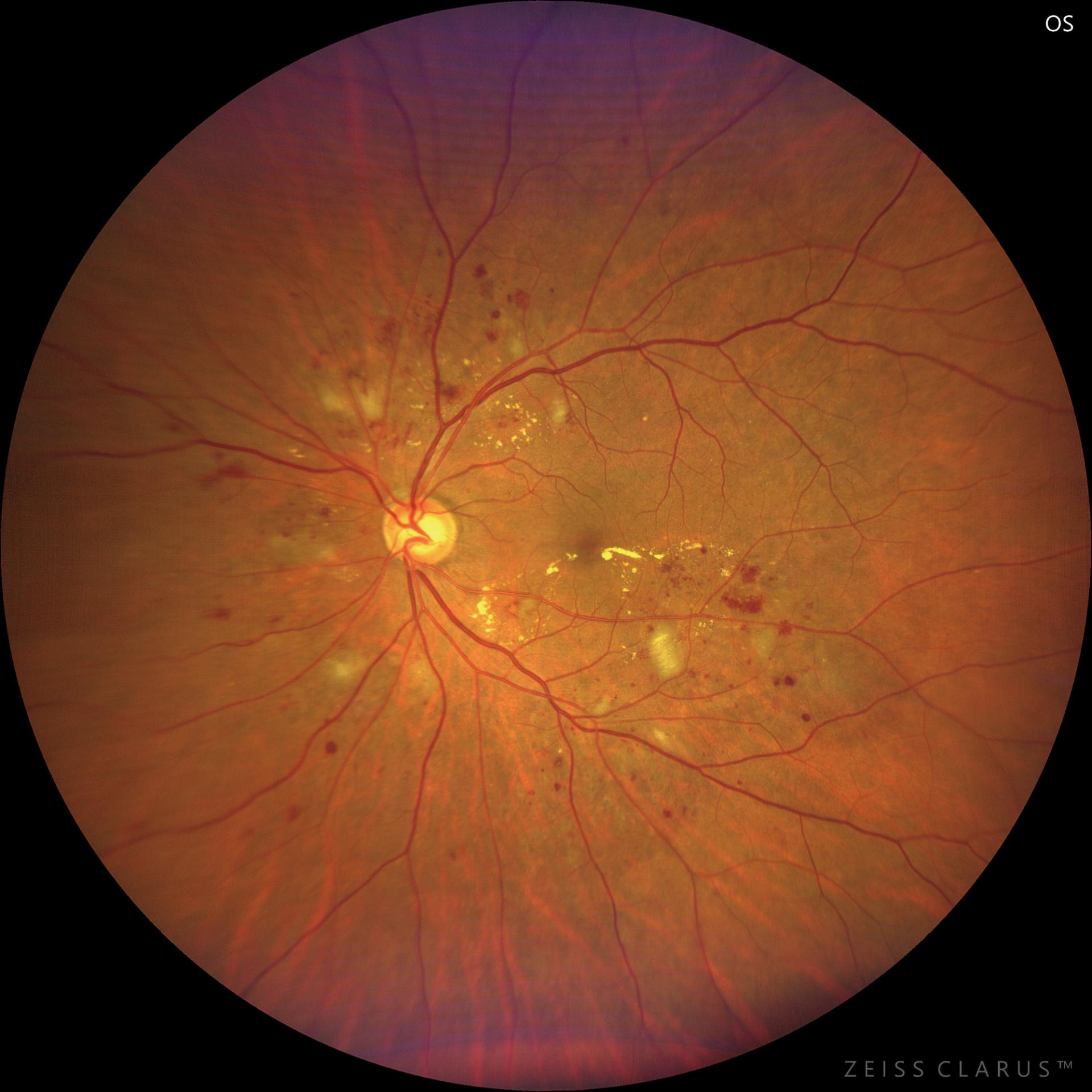 WF 133° magnified image of the macular subauricular hemorrhage area