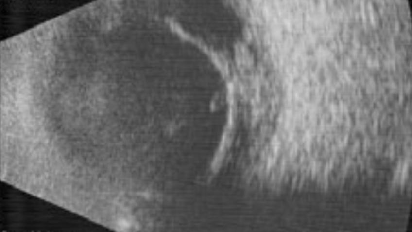 Ultrasound B-mode image