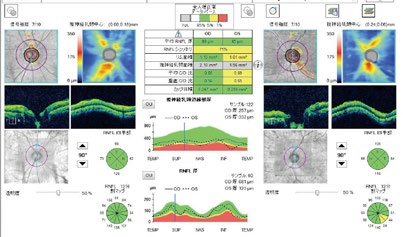 Peripapillary nerve fiber layer analysis of both eyes