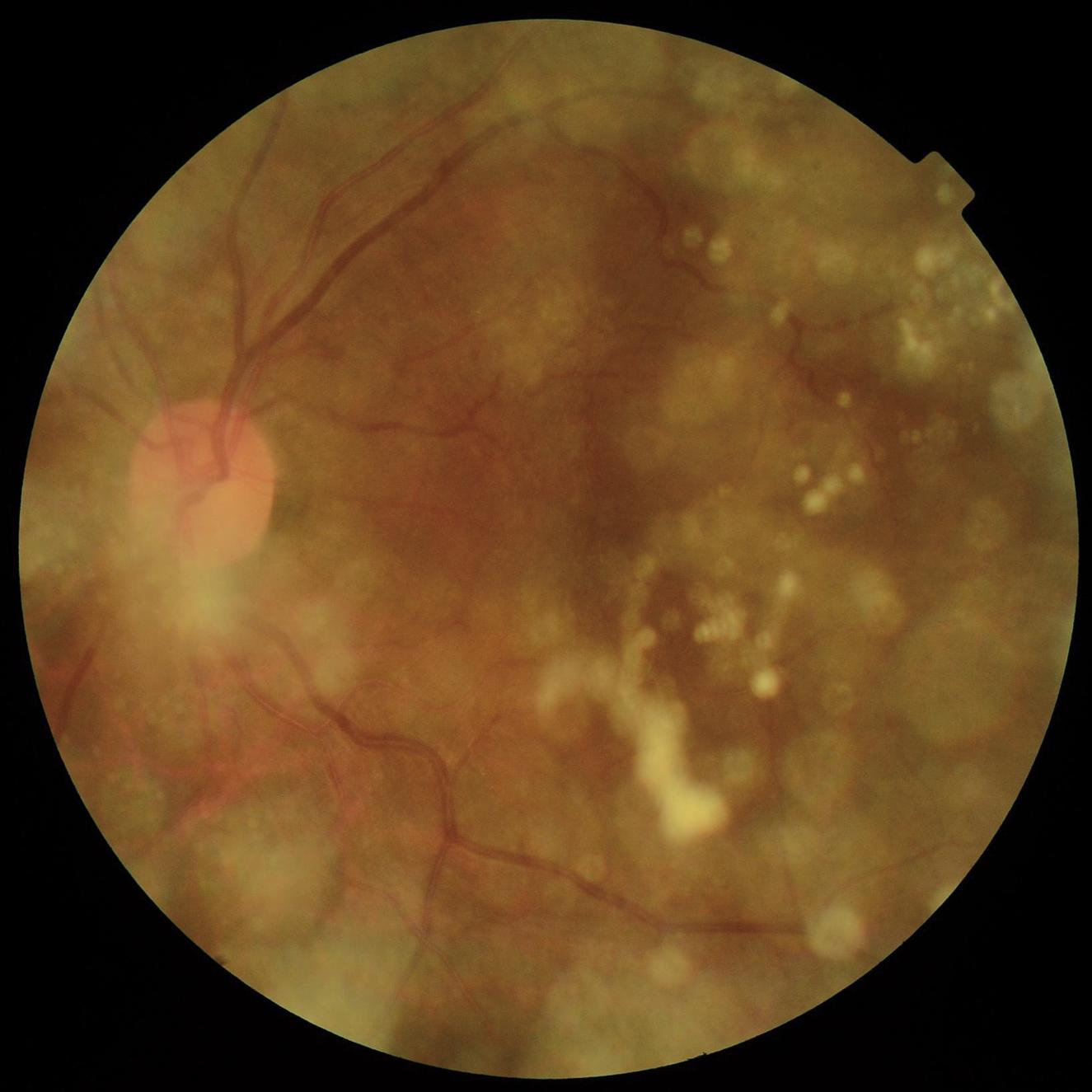 Fundus photograph taken with a conventional fundus camera