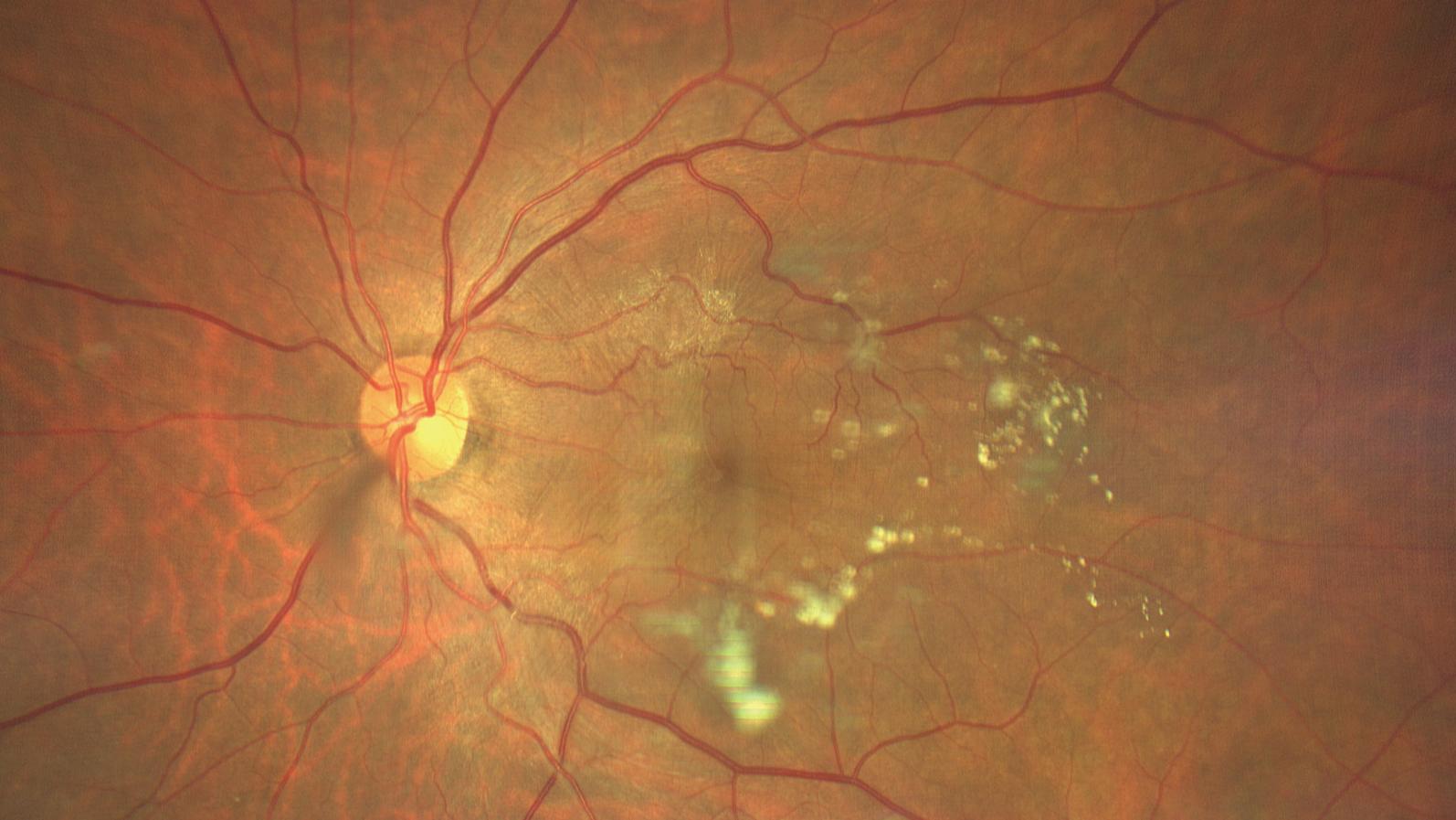  Macular Anterior Membrane (Asteroid Hylalosis) [71-yr old male]
