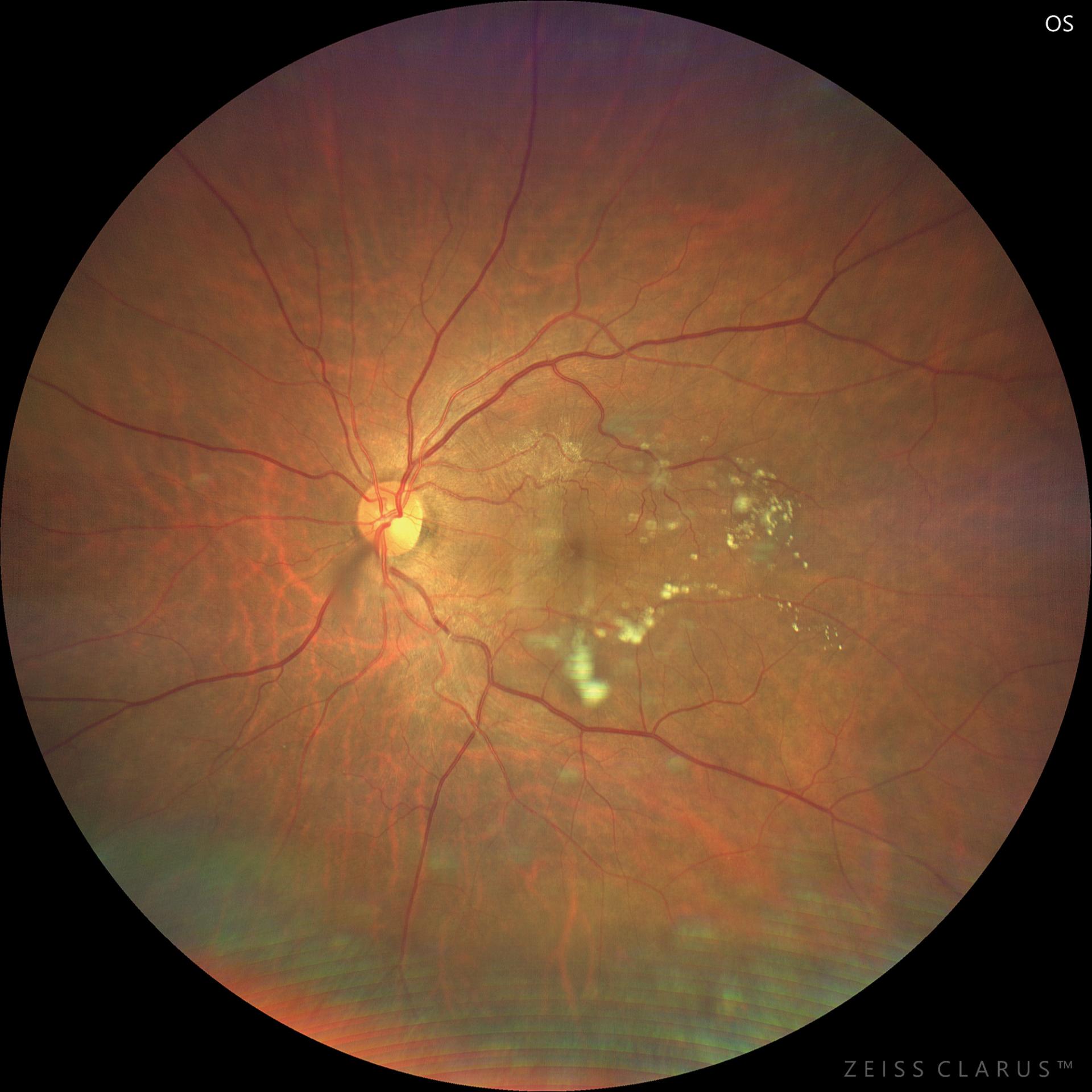 WF 133° magnified image of the macula