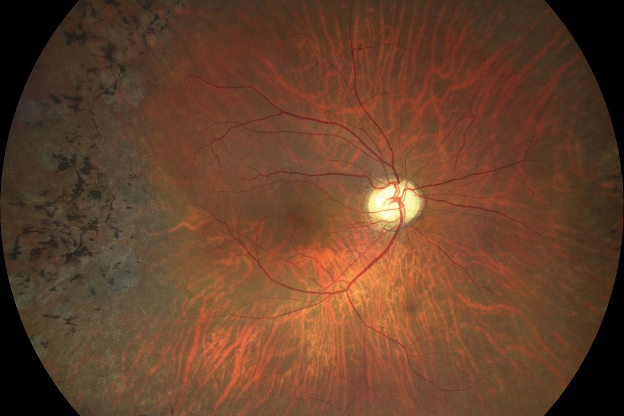 Retinal Pigmentary Degeneration [71-yr old male]