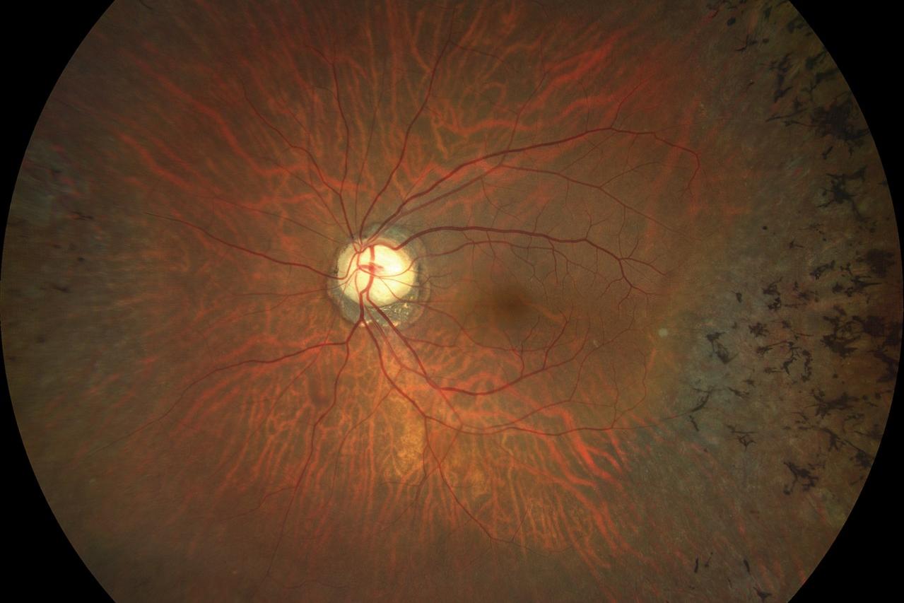 Retinal Pigmentary Degeneration [71-yr old male]