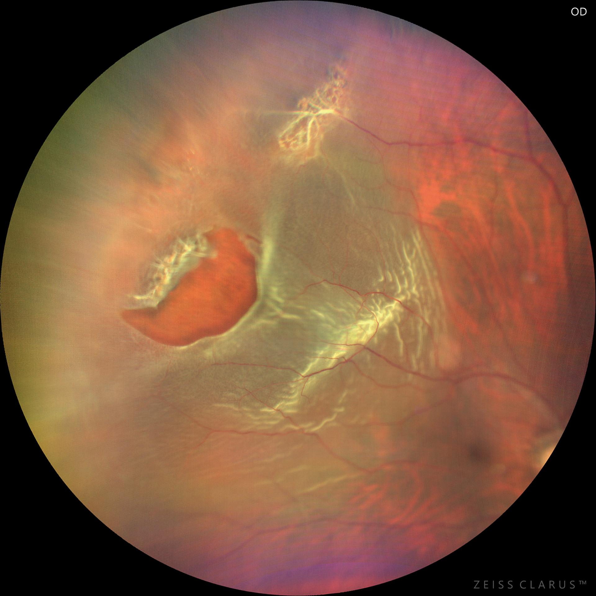 Retinal lattice degeneration and retinal tear