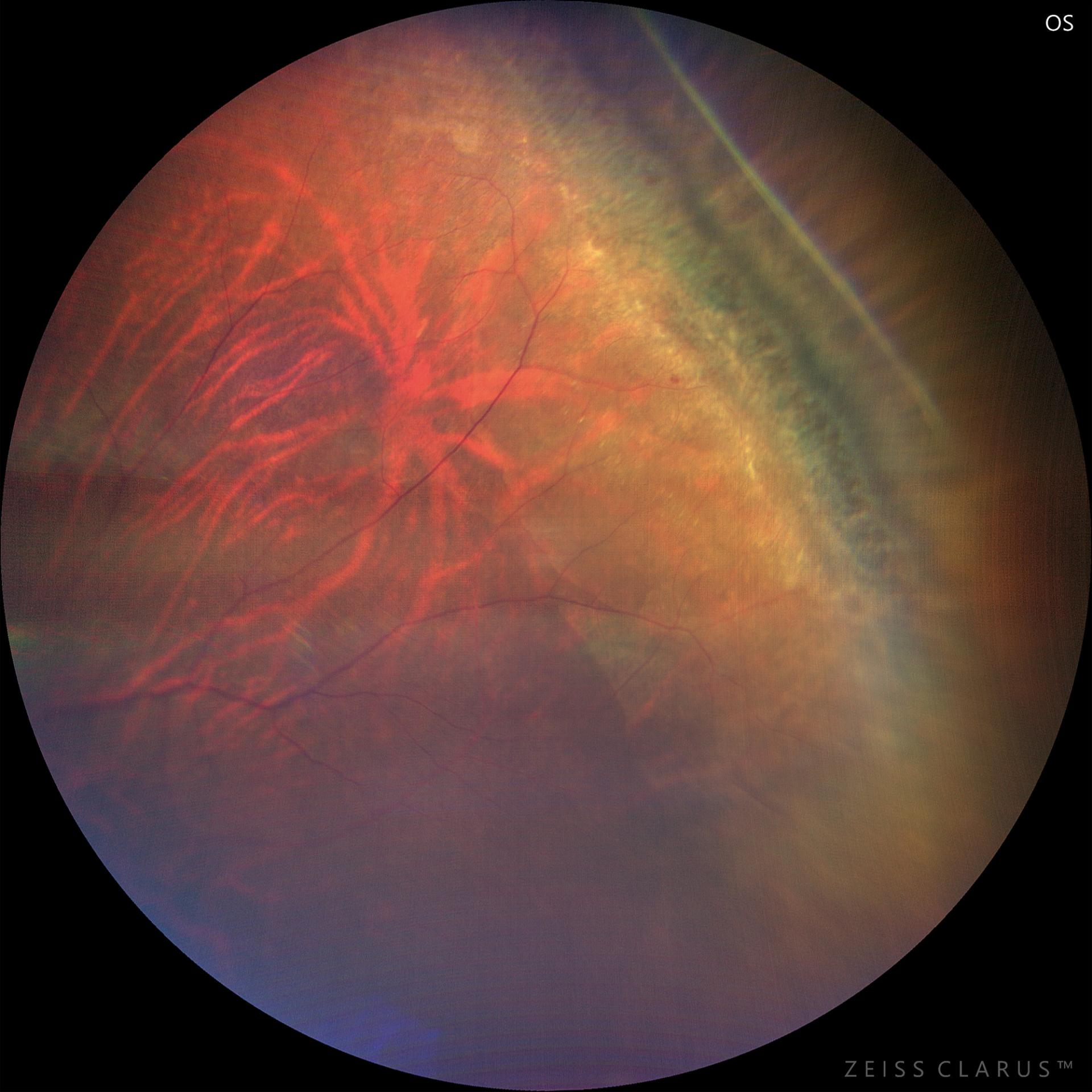 Retinal lattice degeneration