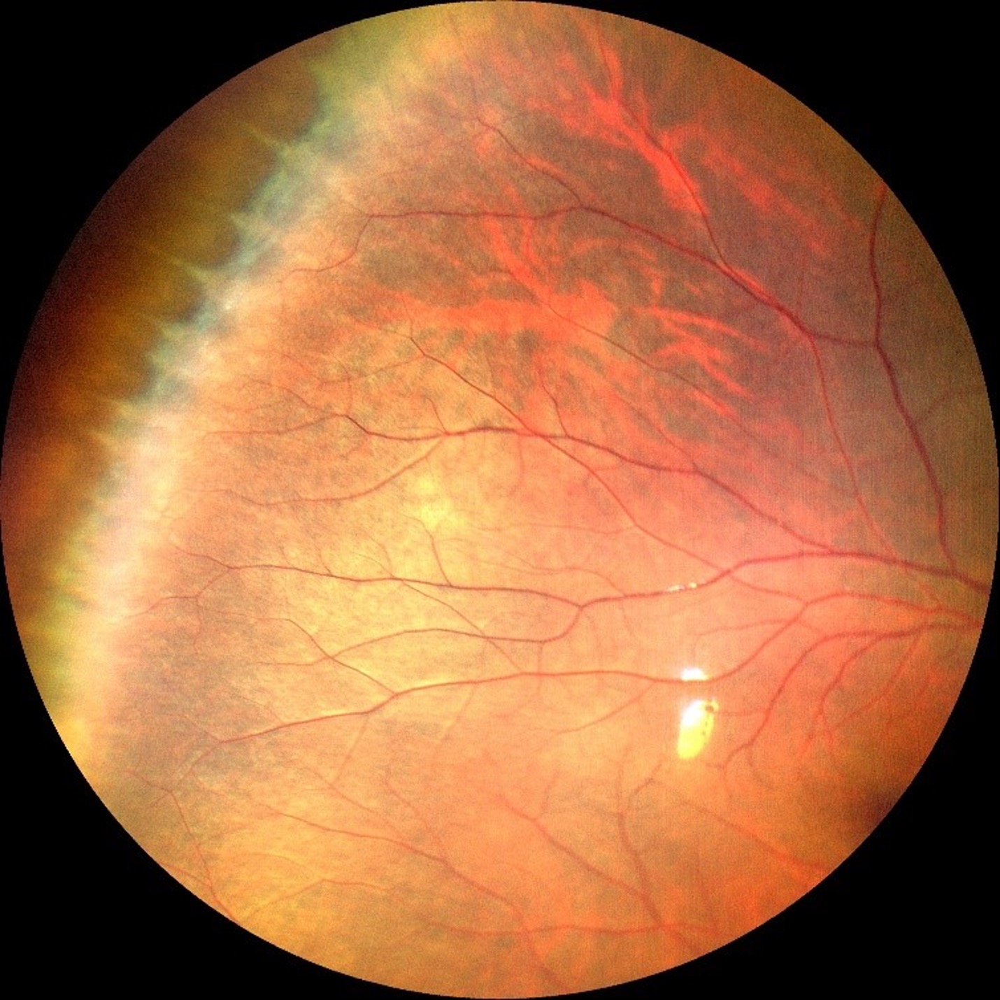 ZEISS CLARUS 500 ultra-wide field image captures peripheral retinal in a myopic eye. 